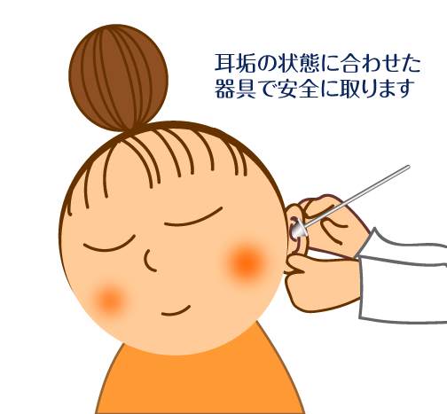 耳垢除去
