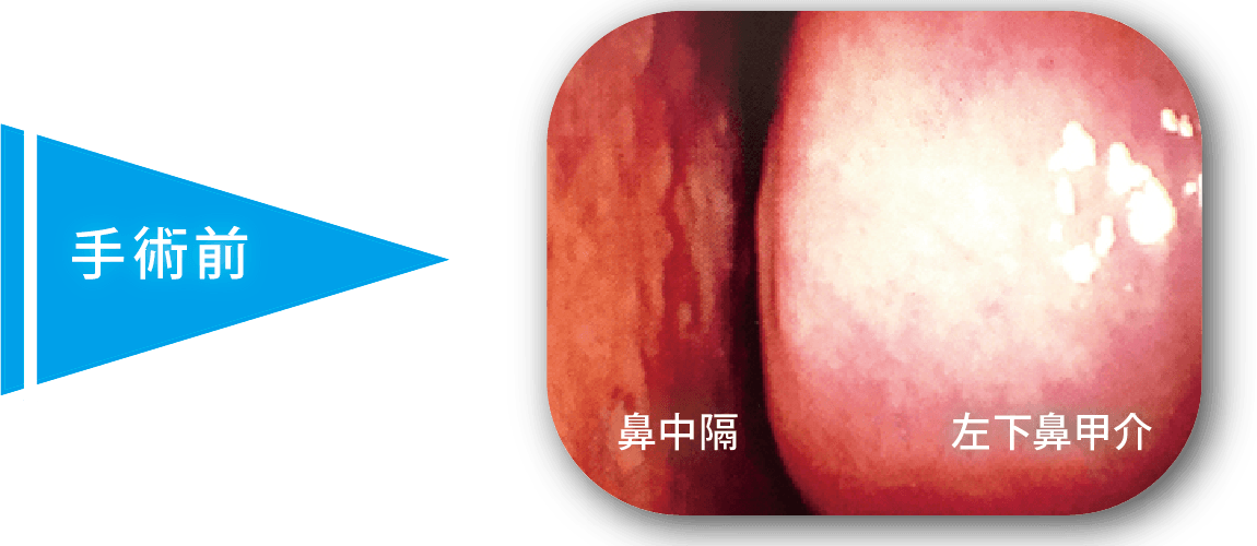 レーザー治療手術前の粘膜