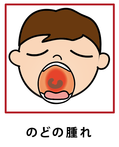 のどの腫れ