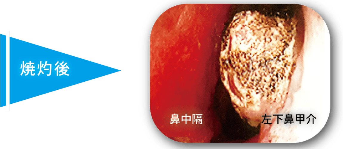 レーザー治療焼却後の粘膜