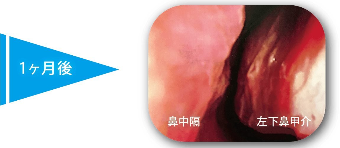 レーザー治療１ヶ月後の粘膜