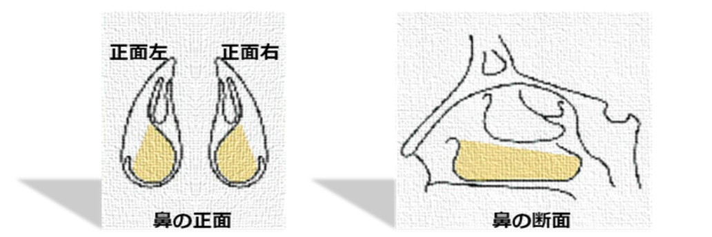 トリクロロ塗布部位